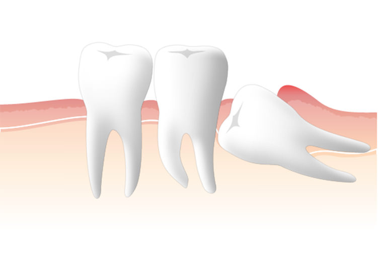 抜歯が必要かどうかを判断する基準